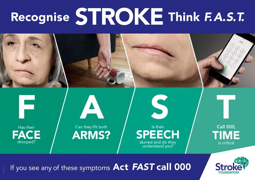 FAST recognise stroke